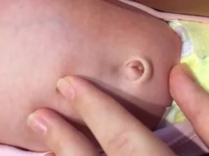 Мокнет пупок у ребенка 3 месяца