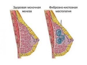 Флюорография при фиброзно-кистозной мастопатии