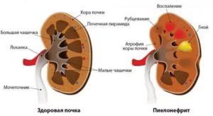 Воспаление почек при орви?