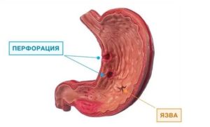 Язва или гастрит