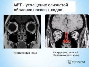 Утолщение слизистой на МРТ