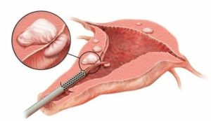 Беременность после гистерорезектоскопии