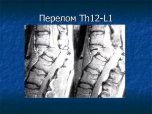 Компрессионный перелом Th12 L1 - есть или нет?