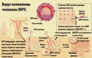 Вирус ВПЧ и дисплазия шейки матки