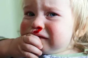 Частые кровотечения из носа у ребенка