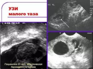 УЗИ органов малого таза, будет видно беременность