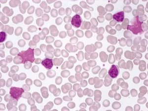B-клеточный хронический лимфоцитарный лейкоз