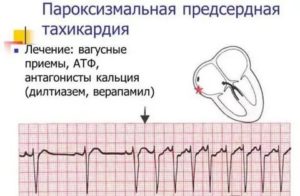 Хроническая тахикардия после испуга
