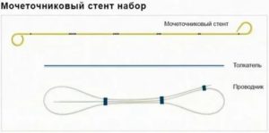 Выбор стента для мочеточника