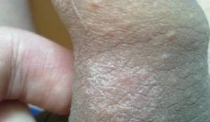 Пятна и местами шелушиться кожа на головке полового члена