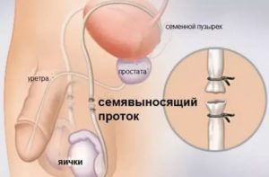 Вазэктомия и вазорезекция
