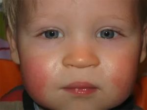 Покраснение на щеках и лбу у ребенка