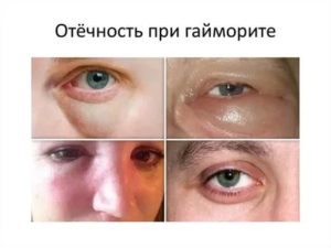 Не проходят отеки лица после гайморита