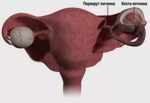 Ленивые яичники