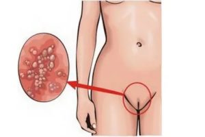 Порвался презерватив на фоне лечения от уреаплазмы парвум