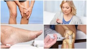Как снять сильное обострение артрита?