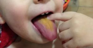 Желтый налет на языке у годовалого ребенка