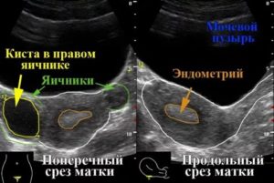 На узи нет матки и яичников