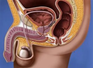 Простатит. Дискомфорт в члене