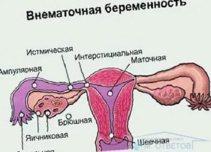 Как забеременеть без двух маточных труб?