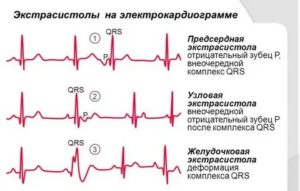 Желудочковая экстрасистолия, низкий пульс