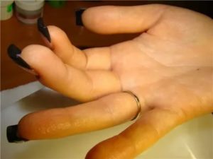 Зуд подушечек пальцев мизинцев, на обоих ногтях лунки, вытекает жидкость