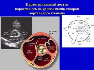 Что делать если в аортальном клапане 2 створки вместо 3?