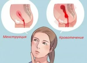 Кровотечение у бабушки