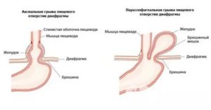 ГПОД и роды