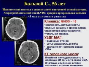 Допустимая нагрузка после инсульта. Диагноз-ишемический(атеротромботический)  инсульт в бассейне ЛСМА,