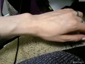 Вздулась вена на запястье