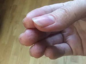 Водянистые пузырьки вокруг ногтя и на подушечках пальцев под ногтем