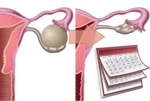 Киста яичника. Жжение внизу живота