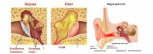 Массаж при отите среднего уха