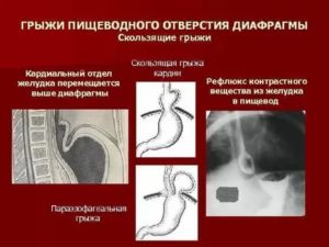 Фитнес и скользящая грыжа в пищеводе