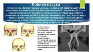 НЕдоразвитие правой лобной пазухи