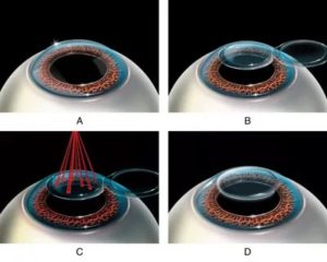 Осложнения после лазерной коррекции зрения методом LASIK