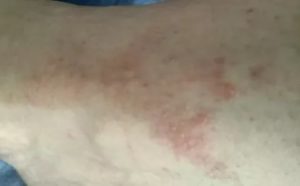 Волдыри на щиколотке правой ноги