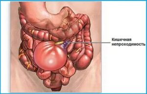 Кишечная непроходимость
