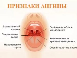 Увеличены миндалины, красное горло без температуры