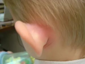 Краснота за ушами у ребенка