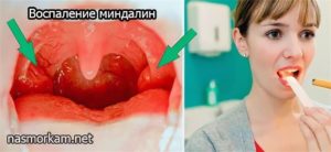 Насморк, заложило оба уха, болит горло