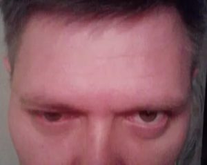 Пройдет ли онемение лба после удара? На лоб наложен шов