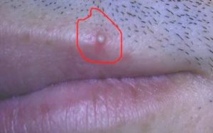 Прыщик на половом члене