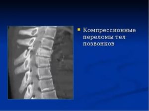 Застарелый компресионный перелом позвонка L 1