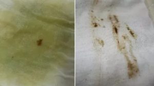 Коричневые выделения с неприятным запахом