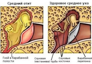 Массаж при отите среднего уха