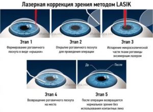 Осложнения после лазерной коррекции зрения методом LASIK