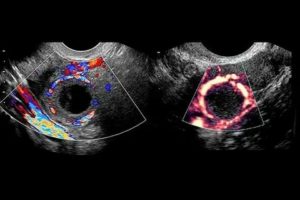 Киста правого яичника и задержка