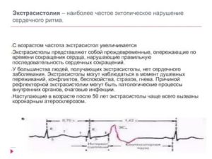 Экстрасистолия после РЧА сердца